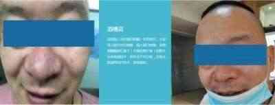 适温消融技术的临床应用