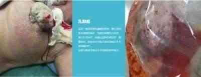 适温消融技术的临床应用